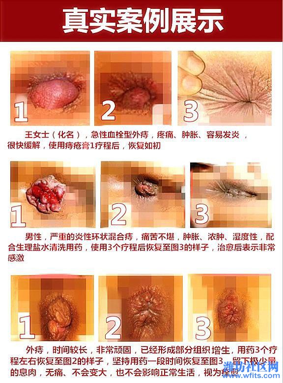 治痔疮2.JPG